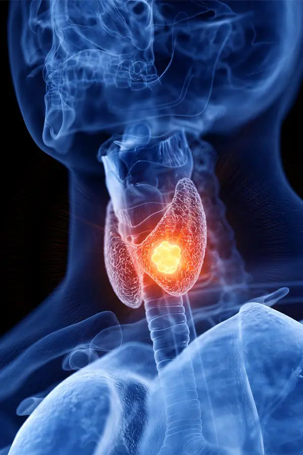 Thyroid-Imbalance-Treatment A 3D illustration of an x-ray of a human neck, highlighting the thyroid. Get help with thyroid imbalance from Optimal Wellness Medical Group in Grand Rapids.